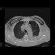 Fluidopneumothorax, pneumomediastinum, subcutaneous emphysema, muscular emphysema, pneumocolum: CT - Computed tomography